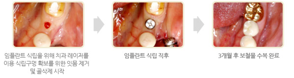 1단계. 임플란트 식립을 위해 치과 레이저를 이용 식립구멍 확보를 위한 잇몸 제거 및 골삭제 시작 / 2단계. 임플란트 식립 직후 / 3단계. 3개월 후 보철물 수복 완료